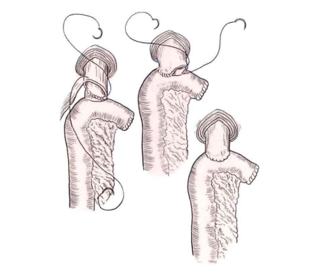 端端吻合器是什么消化道吻合技巧_https://www.jmylbn.com_新闻资讯_第5张