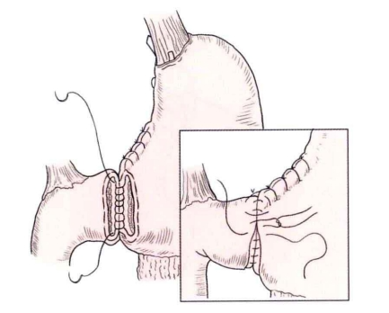 端端吻合器是什么消化道吻合技巧_https://www.jmylbn.com_新闻资讯_第1张