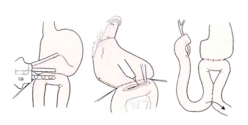 端端吻合器是什么消化道吻合技巧_https://www.jmylbn.com_新闻资讯_第3张