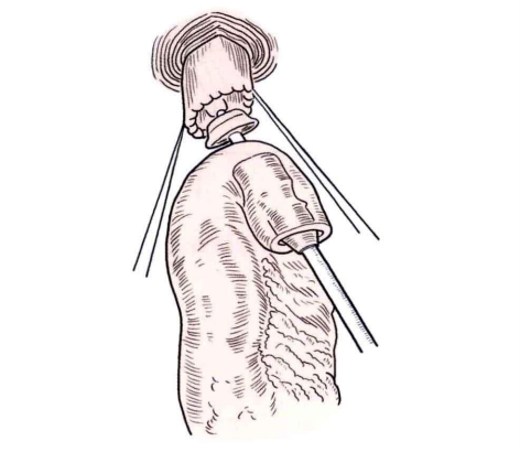 端端吻合器是什么消化道吻合技巧_https://www.jmylbn.com_新闻资讯_第8张