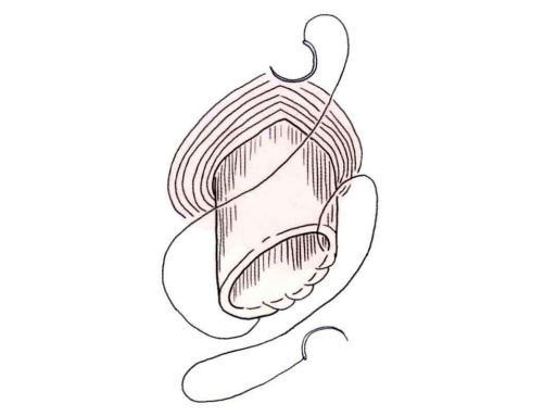 肠道吻合器是什么材质吻合技巧 ｜ 消化道吻合_https://www.jmylbn.com_新闻资讯_第6张