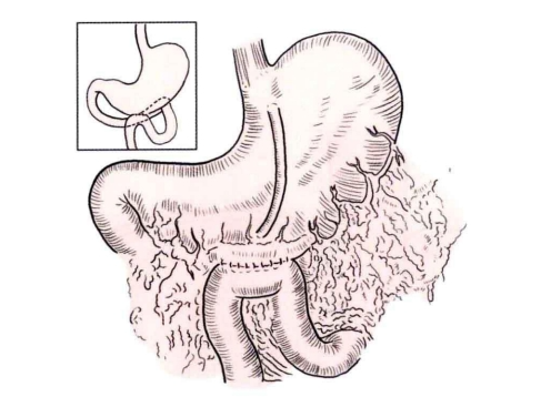 端端吻合器是什么消化道吻合技巧_https://www.jmylbn.com_新闻资讯_第17张