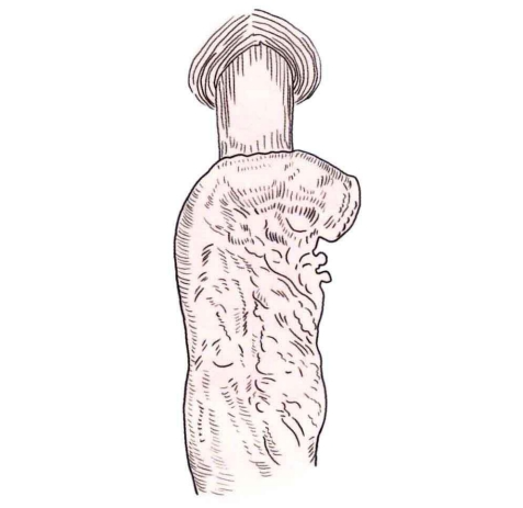 肠道吻合器是什么材质吻合技巧 ｜ 消化道吻合_https://www.jmylbn.com_新闻资讯_第10张