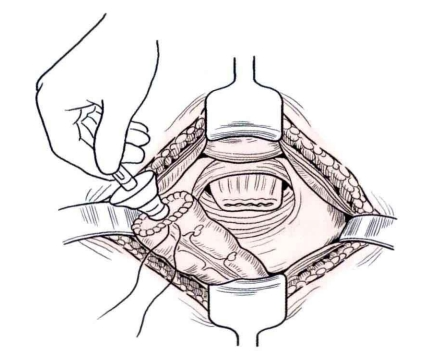肠道吻合器是什么材质吻合技巧 ｜ 消化道吻合_https://www.jmylbn.com_新闻资讯_第25张