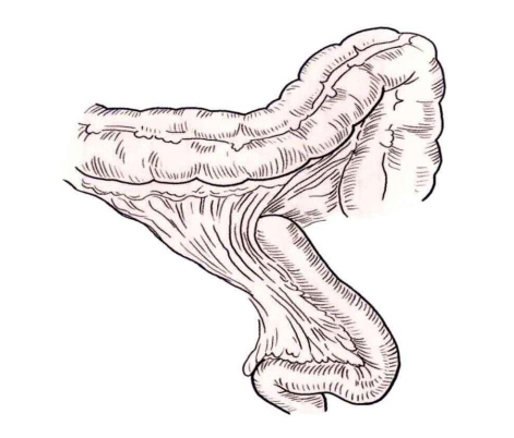 肠道吻合器是什么材质吻合技巧 ｜ 消化道吻合_https://www.jmylbn.com_新闻资讯_第14张