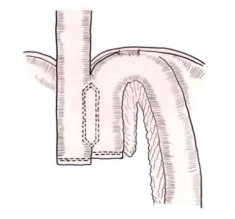 端端吻合器是什么消化道吻合技巧_https://www.jmylbn.com_新闻资讯_第11张