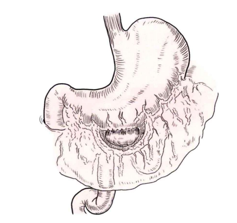 肠道吻合器是什么材质吻合技巧 ｜ 消化道吻合_https://www.jmylbn.com_新闻资讯_第19张