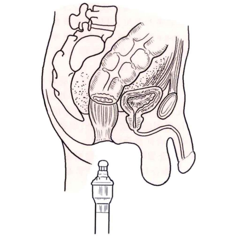 肠道吻合器是什么材质吻合技巧 ｜ 消化道吻合_https://www.jmylbn.com_新闻资讯_第28张
