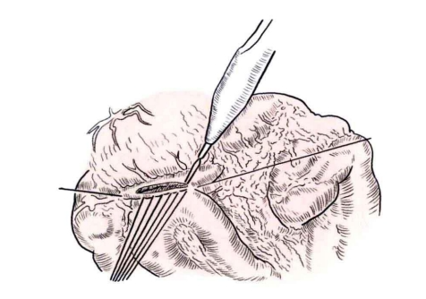 肠道吻合器是什么材质吻合技巧 ｜ 消化道吻合_https://www.jmylbn.com_新闻资讯_第15张