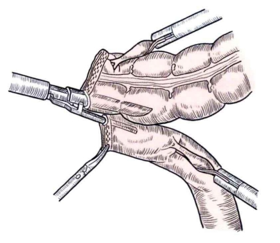 端端吻合器是什么消化道吻合技巧_https://www.jmylbn.com_新闻资讯_第23张