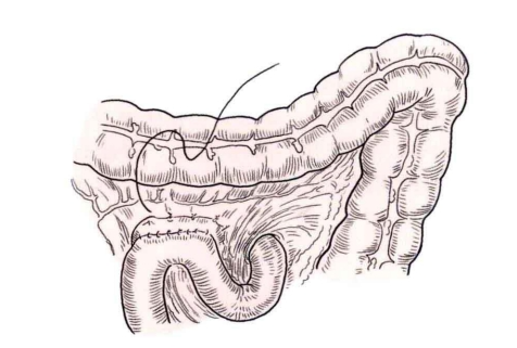 肠道吻合器是什么材质吻合技巧 ｜ 消化道吻合_https://www.jmylbn.com_新闻资讯_第20张