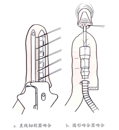 肠道吻合器是什么材质吻合技巧 ｜ 消化道吻合_https://www.jmylbn.com_新闻资讯_第12张
