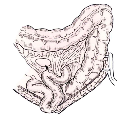 肠道吻合器是什么材质吻合技巧 ｜ 消化道吻合_https://www.jmylbn.com_新闻资讯_第18张