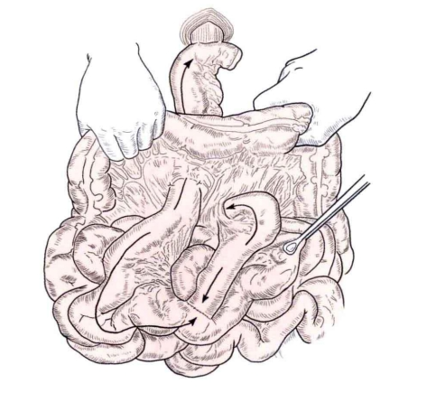 端端吻合器是什么消化道吻合技巧_https://www.jmylbn.com_新闻资讯_第4张