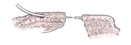 肠道吻合器是什么材质吻合技巧 ｜ 消化道吻合_https://www.jmylbn.com_新闻资讯_第24张