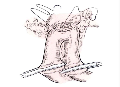 端端吻合器是什么消化道吻合技巧_https://www.jmylbn.com_新闻资讯_第16张