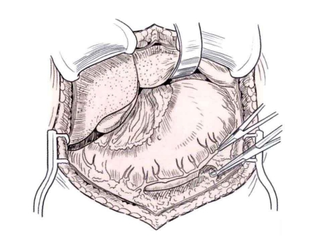 肠道吻合器是什么材质吻合技巧 ｜ 消化道吻合_https://www.jmylbn.com_新闻资讯_第13张
