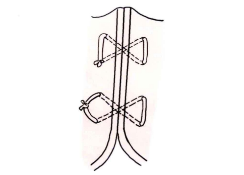 小儿的PDS怎么缝的缝合要点 ｜ 单纯对合缝合_https://www.jmylbn.com_新闻资讯_第19张