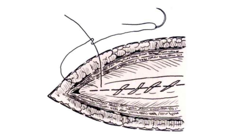 小儿的PDS怎么缝的缝合要点 ｜ 单纯对合缝合_https://www.jmylbn.com_新闻资讯_第16张