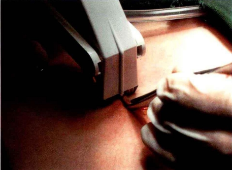 小儿的PDS怎么缝的缝合要点 ｜ 单纯对合缝合_https://www.jmylbn.com_新闻资讯_第35张