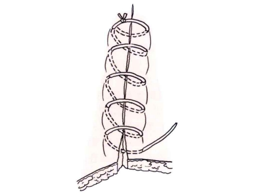 小儿的PDS怎么缝的缝合要点 ｜ 单纯对合缝合_https://www.jmylbn.com_新闻资讯_第7张