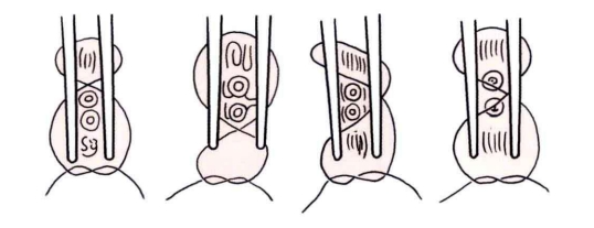小儿的PDS怎么缝的缝合要点 ｜ 单纯对合缝合_https://www.jmylbn.com_新闻资讯_第22张