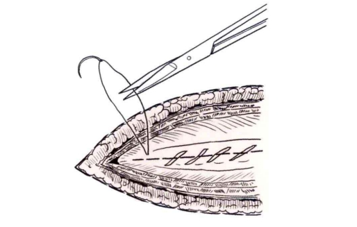 小儿的PDS怎么缝的缝合要点 ｜ 单纯对合缝合_https://www.jmylbn.com_新闻资讯_第15张