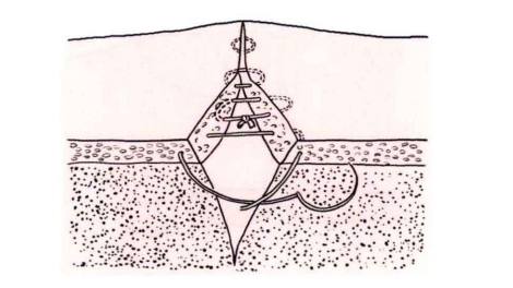 小儿的PDS怎么缝的缝合要点 ｜ 单纯对合缝合_https://www.jmylbn.com_新闻资讯_第29张