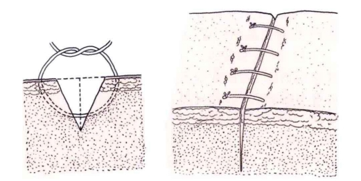 小儿的PDS怎么缝的缝合要点 ｜ 单纯对合缝合_https://www.jmylbn.com_新闻资讯_第4张
