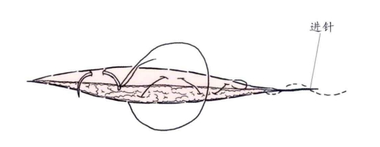小儿的PDS怎么缝的缝合要点 ｜ 单纯对合缝合_https://www.jmylbn.com_新闻资讯_第32张