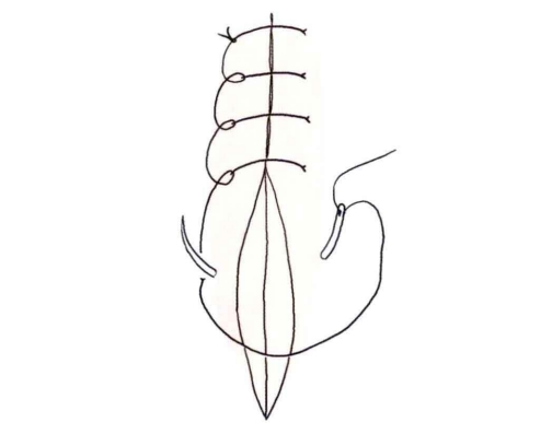 小儿的PDS怎么缝的缝合要点 ｜ 单纯对合缝合_https://www.jmylbn.com_新闻资讯_第10张