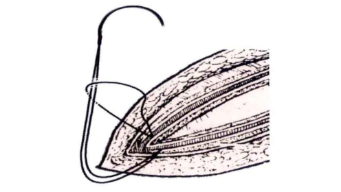 小儿的PDS怎么缝的缝合要点 ｜ 单纯对合缝合_https://www.jmylbn.com_新闻资讯_第14张