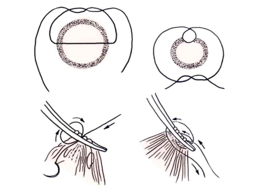 小儿的PDS怎么缝的缝合要点 ｜ 单纯对合缝合_https://www.jmylbn.com_新闻资讯_第23张