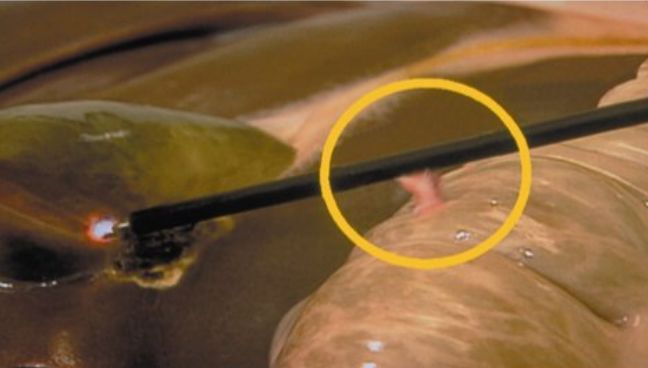 手术怎么止血腹腔镜术中止血技巧与器械_https://www.jmylbn.com_新闻资讯_第4张