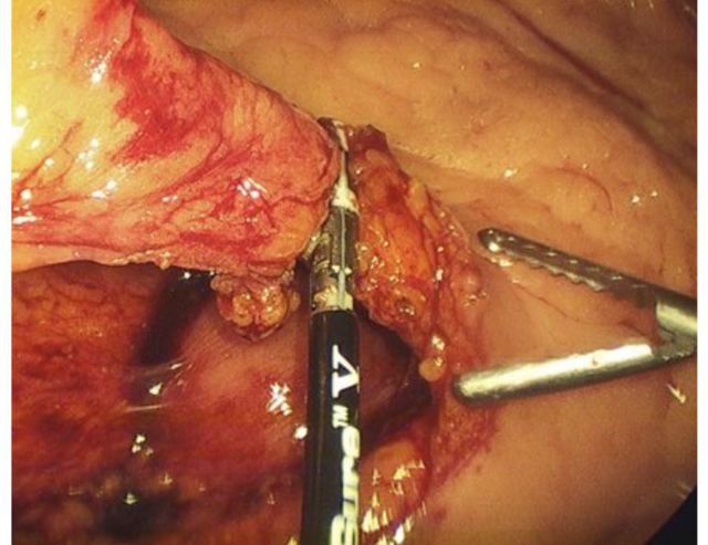 手术怎么止血腹腔镜术中止血技巧与器械_https://www.jmylbn.com_新闻资讯_第5张