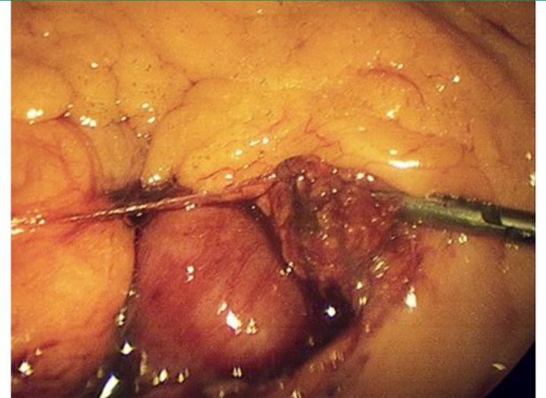 手术怎么止血腹腔镜术中止血技巧与器械_https://www.jmylbn.com_新闻资讯_第6张