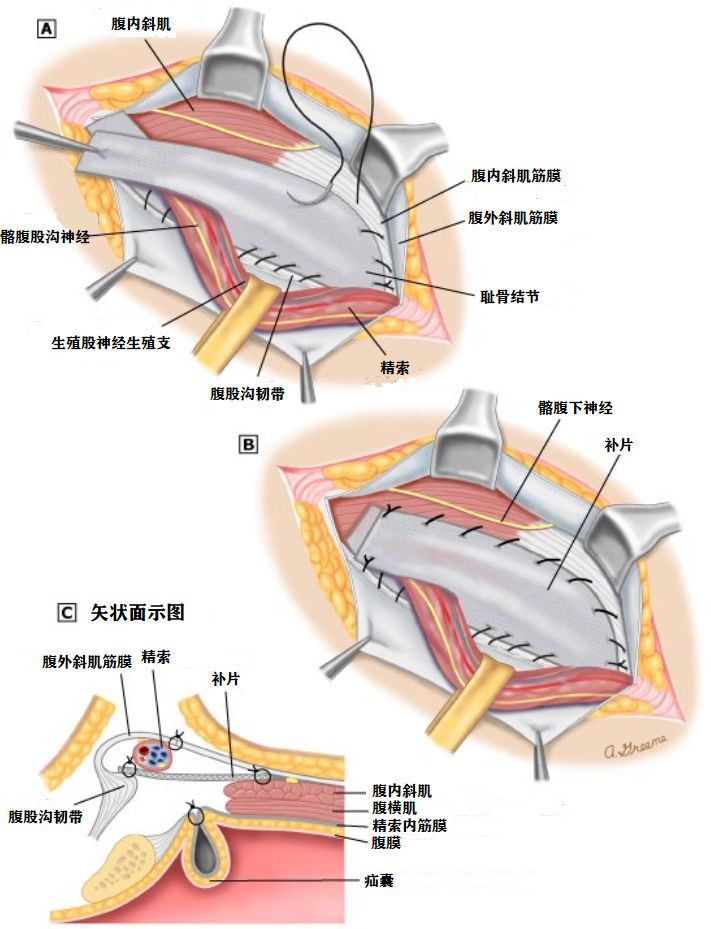 术式详解 Lichtenstein腹股沟疝修补术 普外科 微信公众号文章阅读 Wemp