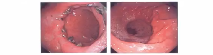 直肠吻合器钉子什么样结直肠手术缝合技术和缝线选择_https://www.jmylbn.com_新闻资讯_第23张