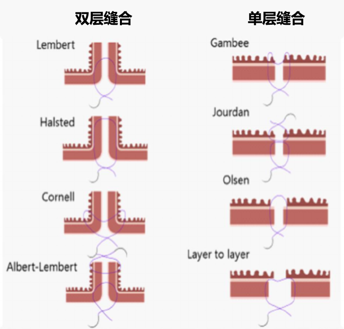 直肠吻合器钉子什么样结直肠手术缝合技术和缝线选择_https://www.jmylbn.com_新闻资讯_第8张