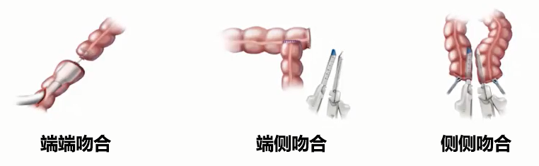 直肠吻合器钉子什么样结直肠手术缝合技术和缝线选择_https://www.jmylbn.com_新闻资讯_第16张