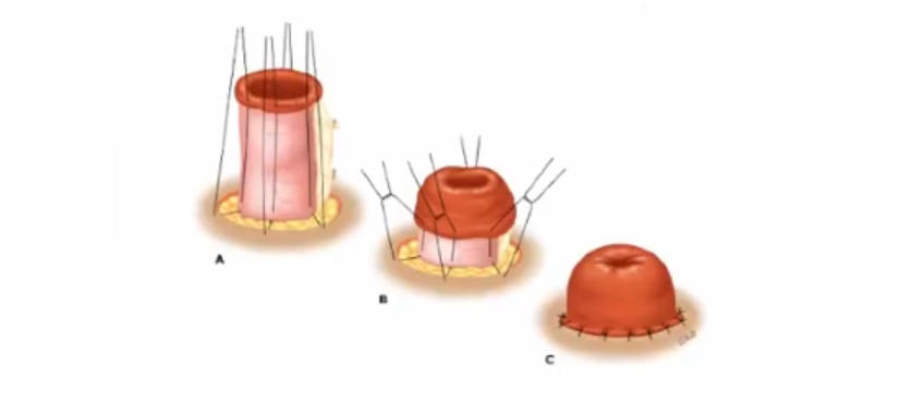 直肠吻合器钉子什么样结直肠手术缝合技术和缝线选择_https://www.jmylbn.com_新闻资讯_第19张