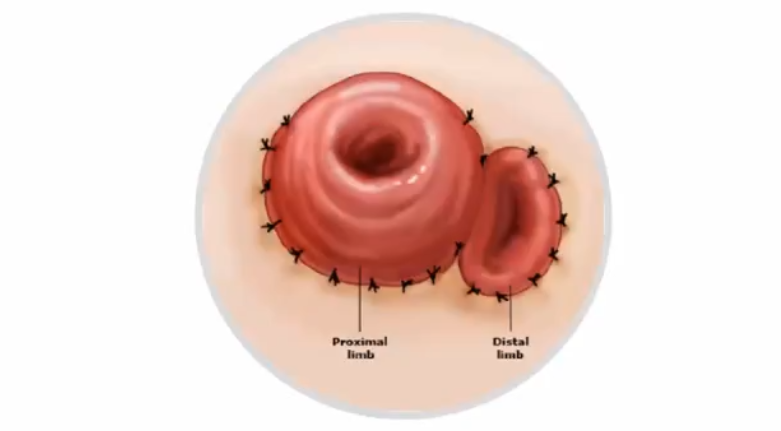 直肠吻合器钉子什么样结直肠手术缝合技术和缝线选择_https://www.jmylbn.com_新闻资讯_第20张