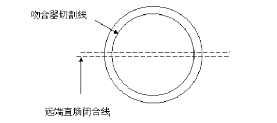 吻合器怎么使用方法医加百科 ｜ 使用吻合器的注意事项及常见问题_https://www.jmylbn.com_新闻资讯_第2张