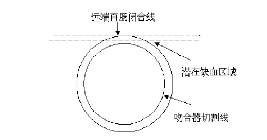 吻合器怎么使用方法医加百科 ｜ 使用吻合器的注意事项及常见问题_https://www.jmylbn.com_新闻资讯_第3张