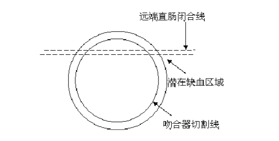 吻合器怎么使用方法医加百科 ｜ 使用吻合器的注意事项及常见问题_https://www.jmylbn.com_新闻资讯_第4张