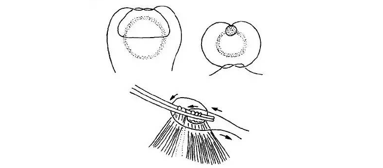 缝合手法大盘点_医学界-助力医生临床决策和职业成长
