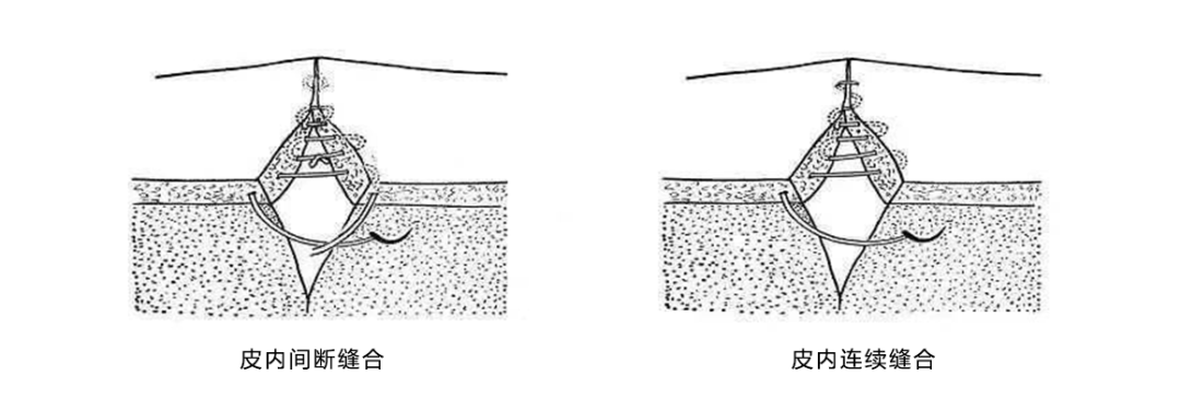 缝合手法大盘点_医学界-助力医生临床决策和职业成长