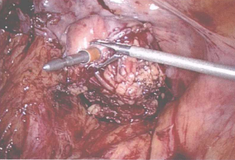 直肠吻合器钉子什么样腹腔镜结直肠手术 ｜ 吻合技术_https://www.jmylbn.com_新闻资讯_第4张