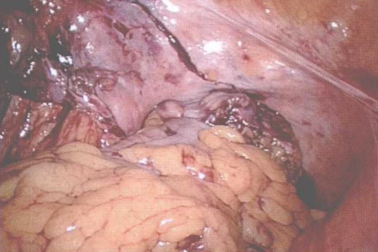 直肠吻合器钉子什么样腹腔镜结直肠手术 ｜ 吻合技术_https://www.jmylbn.com_新闻资讯_第8张