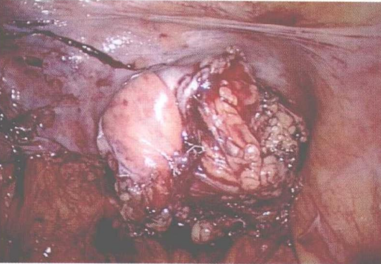 直肠吻合器钉子什么样腹腔镜结直肠手术 ｜ 吻合技术_https://www.jmylbn.com_新闻资讯_第3张